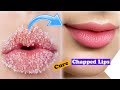 How to Cure Chapped Dry Lips In 5 Minutes