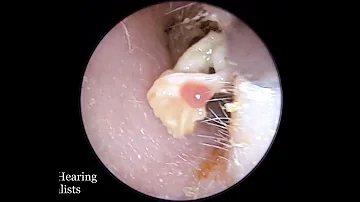 Unusual Discharge Discovered in Ear Canal after Infection (Serosanguinous Fluid)