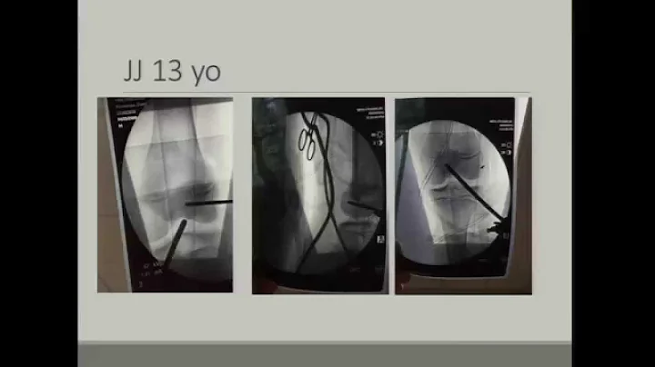 ACL Injury in the Skeletally Immature Patient | Damian Kosempa, MD