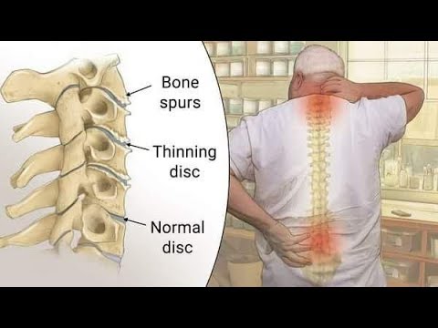 Watch Video Treatment of Cervical Spondylosis with Ayurvedic Herbs