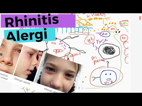 Rhinitis Alergi - Patofisiologi, Diagnosis,  Tatalaksana