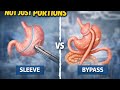 Sleeve or Bypass: Choosing the Wrong One Costs Years