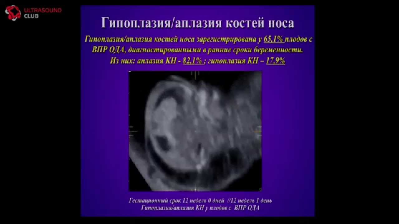 Пренатальная диагностика пороков опорно-двигательного аппарата в ранние сроки беременности