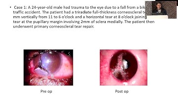 AIOCMTC4 2025   FP320 Dr Nidhi Mundada   Demographic profile and visual outcome in open globe inj