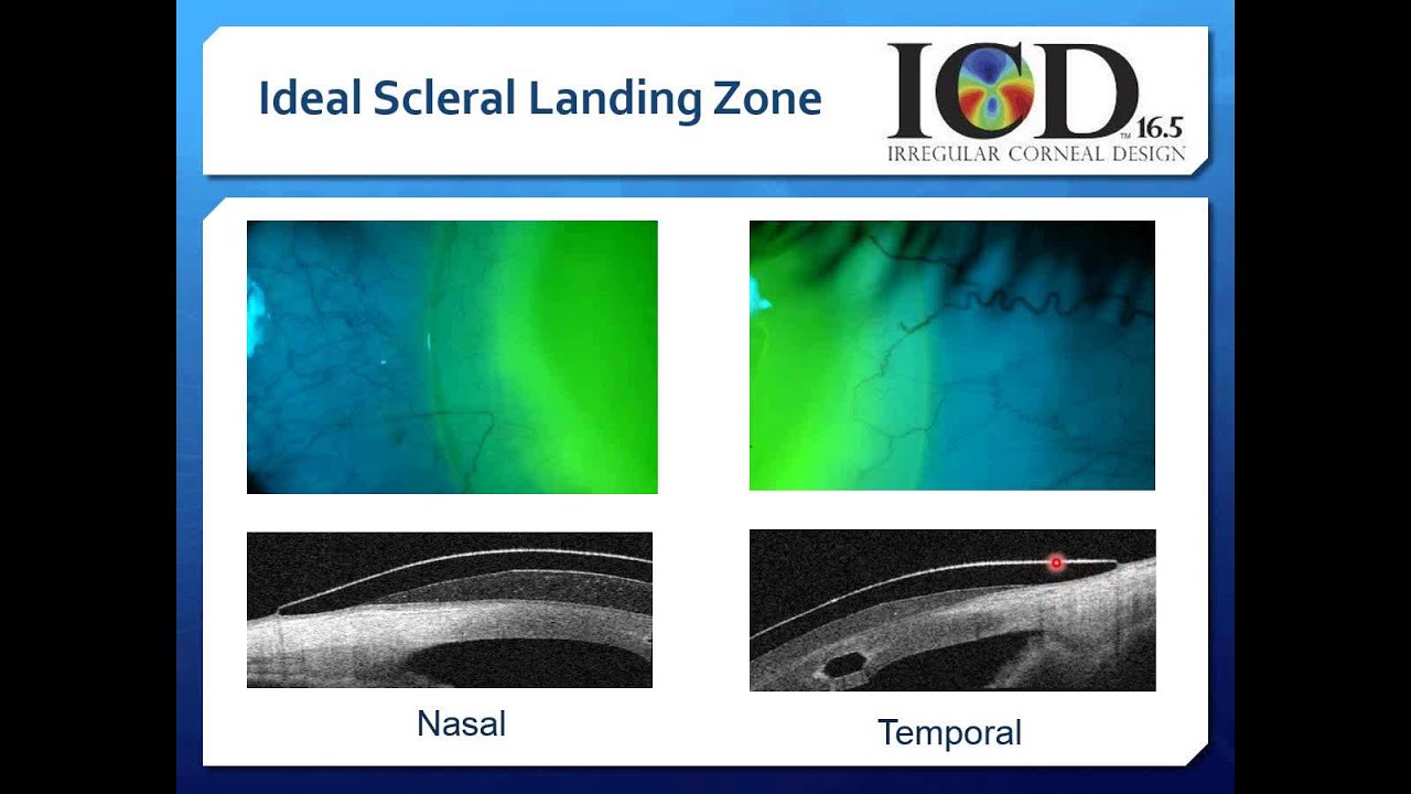 Scleral Contact Lenses Video 5 YouTube