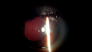 Iris atrophy, retroillumination