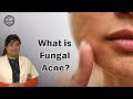 What is Fungal Acne | How to get rid of Fungal Acne [Tips & Treatment] 2021
