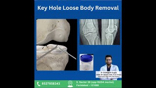 Knee Loose Body Removal (Key Hole Surgery) #arthroscopy