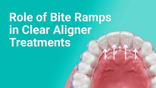 Bite Ramps in Clear Aligner Treatments: Orthodontic Expertise Unveiled