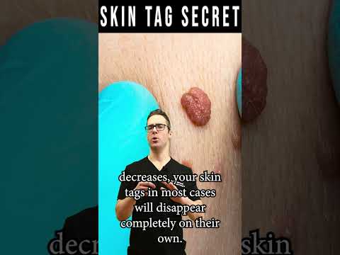 Video: 4 måder at slippe af med hudmærker