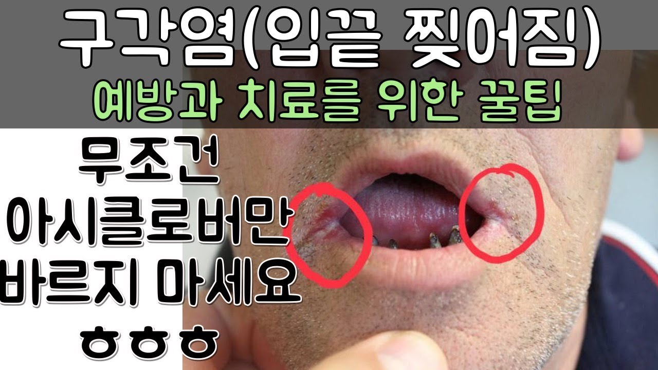 입술 끝이 찢어지는 구각염!! 치료에 도움 되는 꿀 팁!! ( 구각염의 원인과 치료 방법 예방하는 법을 알아보아요)
