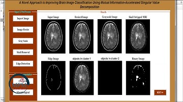 An Approach to Improving Brain Image Classification Using Mutual Information of SVD using MATLAB