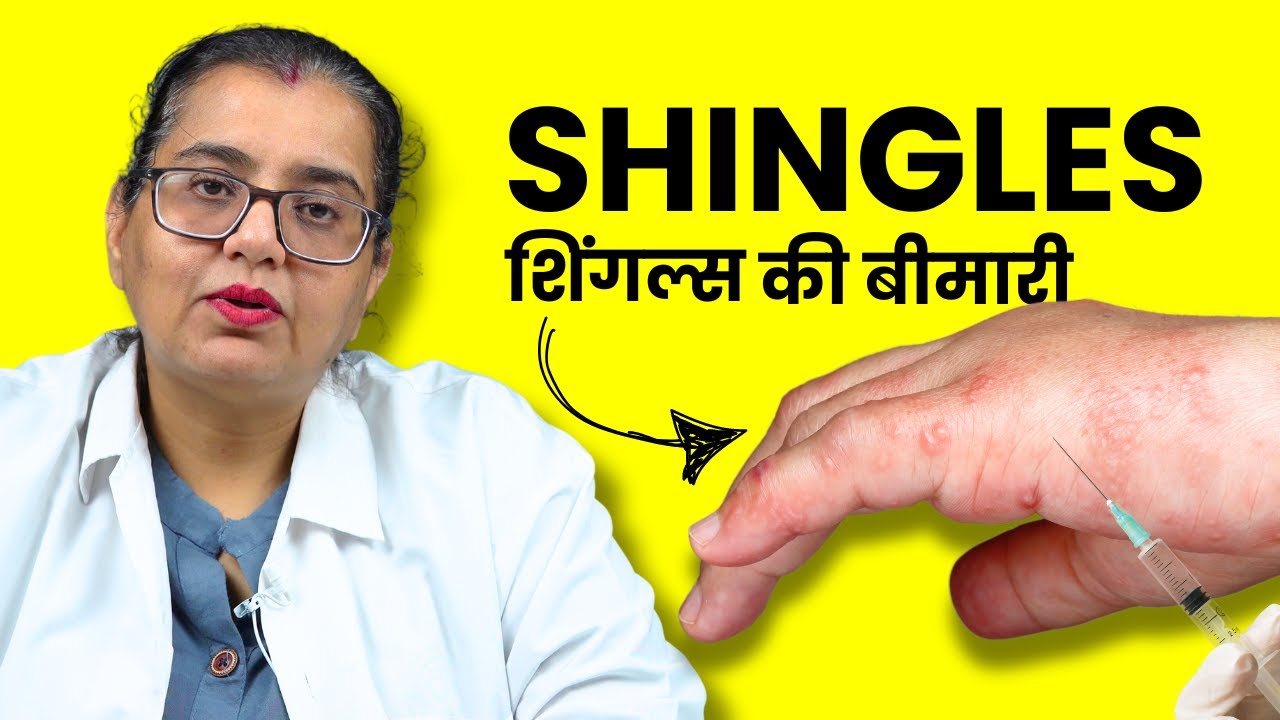 Shingles Ki Bimari Kya Hoti Hai? Kaise Hoti Hai? Symptoms, Vaccine