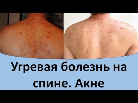 Угревая сыпь на спине