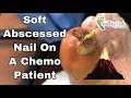 Fungal Nail with Dried Abscess, How To Rid Nail Fungus, Nail Fungus Cure For Thick Fungal Toenail