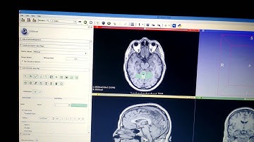 Medical robotics - Assignment 3 3D slicer demo