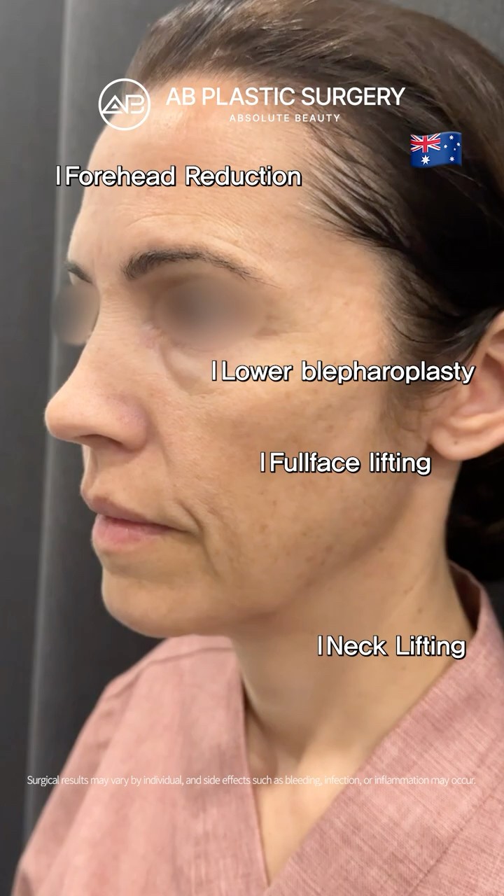 Forehead Reduction + Lower Blepharoplasty + Facelift Results ✨ #Shorts