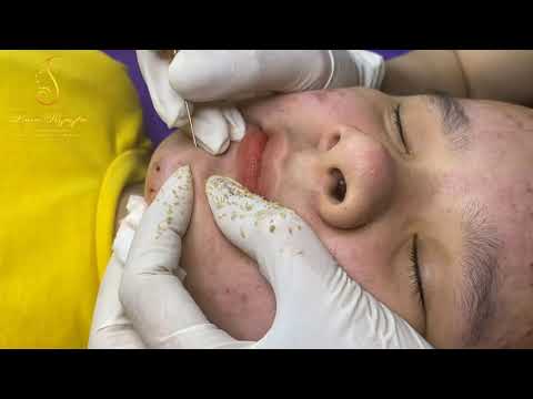 Blackheads and whiteheads (272_ep2) | Loan Nguyen