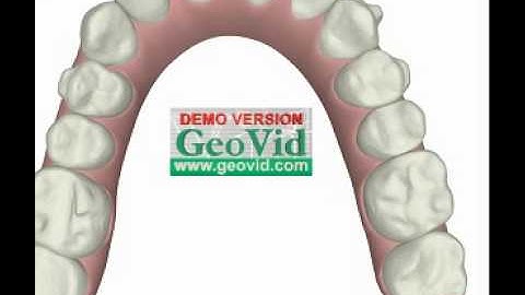 Invisalign Refinements Upper Arch