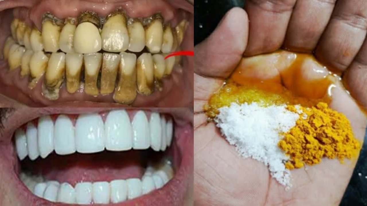 สูตรลับจากทันตแพทย์จีน ฟันขาวคราบหินปูนหลุดในสองนาที