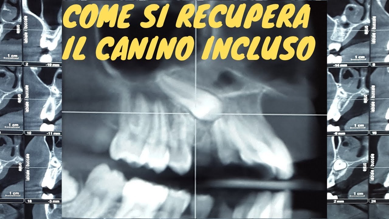 Come si recupera il canino incluso