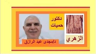 مرض الزهري وطرق فحصه