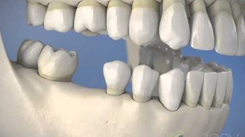 Implants: Partially Edentulous
