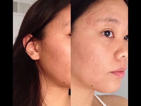 Acne Scar progression video with voiceover and before and after photos!! =)