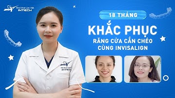 REVIEW NIỀNG RĂNG TRONG SUỐT INVISALIGN| KẾT QUẢ NIỀNG RĂNG INVASALIGN