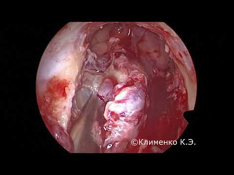 Расширенная эндоскопическая фронтотомия после декомпрессии орбит.