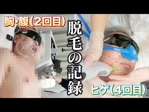 【脱毛の記録】岩尾のヒゲ脱毛【ヤグレーザー】