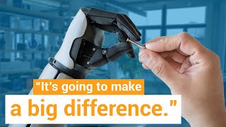 Andy Gets a Bionic Arm After 32 Years of not Wearing a Prosthesis