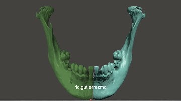 Mandibular Defect Segment Mirroring BG3D