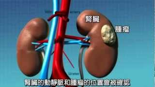 【腎臟癌】達文西切除手術--只切除腫瘤,但可保留腎臟的先進手術