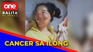 Sino nga ba ang mga high risk sa cancer sa ilong?