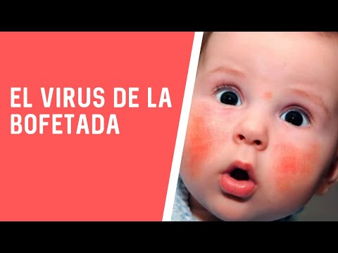 Video: ¿Qué virus causa la enfermedad de las bofetadas?