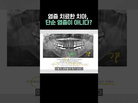 염증 치료한 치아, 단순 염증이 아니다?