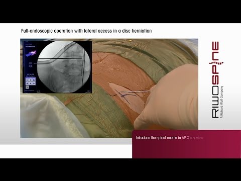 RIWOspine - Full-endoscopic spine surgery with lumbar transforaminal access