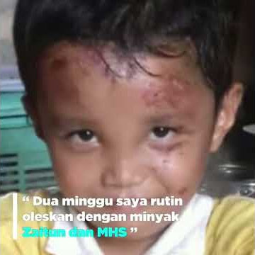 HNI HPAI : TESTIMONI ZAITUN SEMBUHKAN LUKA DI WAJAH