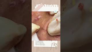 Big Cystic Acne Blackheads Extraction Blackheads & Milia, Whiteheads Removal Pimple Popping
