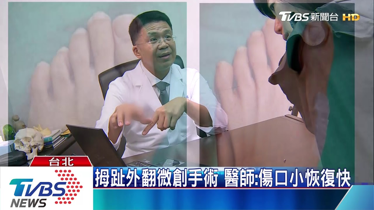 拇趾外翻微創手術醫師 傷口小恢復快 Youtube