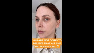 These Fraxel results will blow your mind!