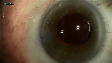 Phacoemulsification: Wound Hydration for Wound Sealing