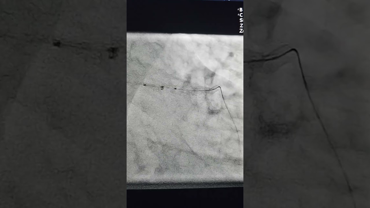 Пример 24: Комплексный LAD CTO — важность инвентаризации и стратегической гибкости