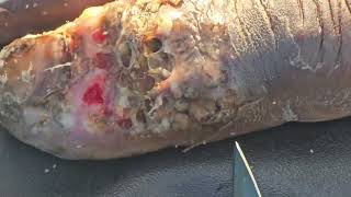 Mary Owendi's jigger dig - BUG CLUSTERS #6 --- watch long videos @riseupsociety.net \u0026 @ruskenya.org