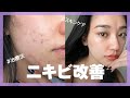 【ニキビ・ニキビ跡】最近、肌荒れが治ってきてお肌の調子がよくなってきました！私が試してるスキンケアなど