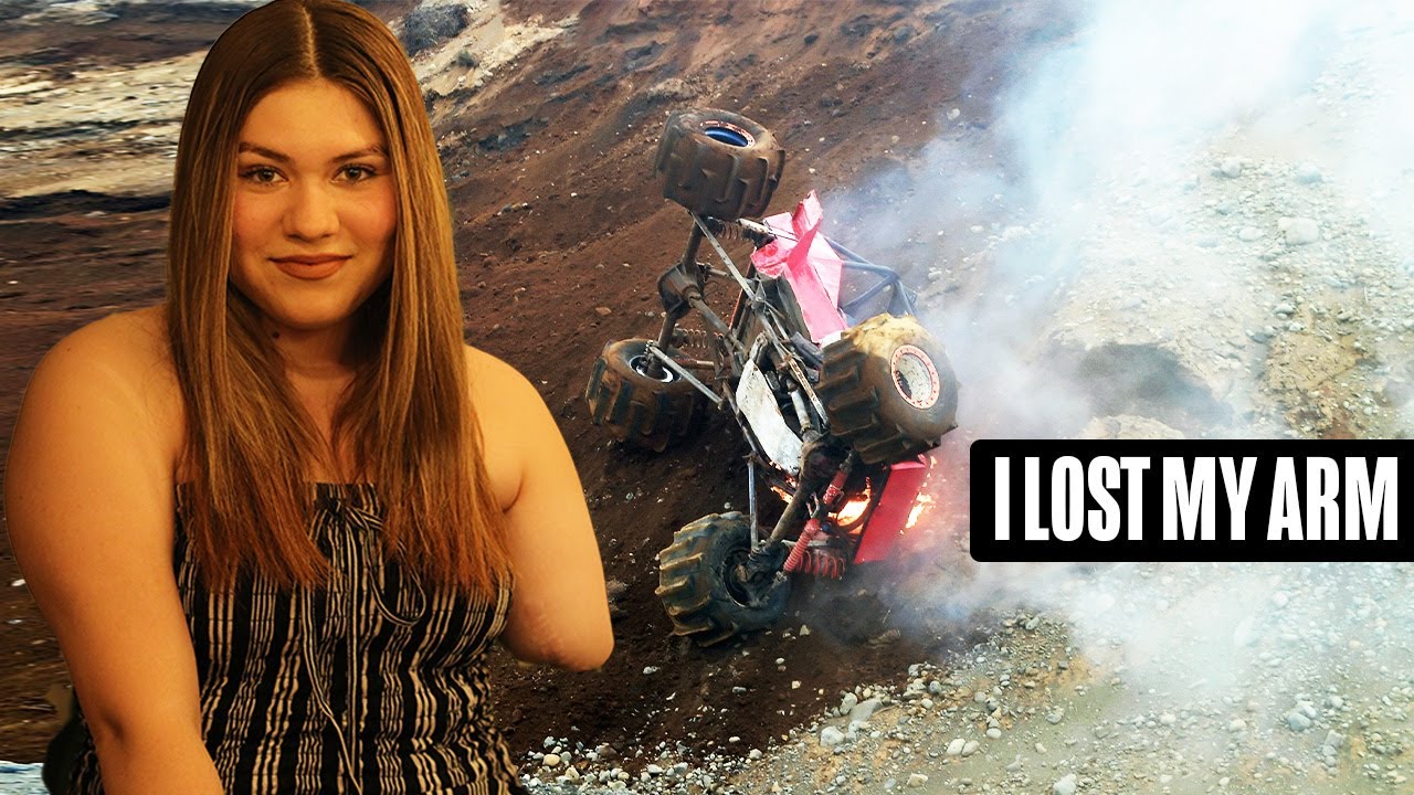 I Lost My Arm In An ATV Accident