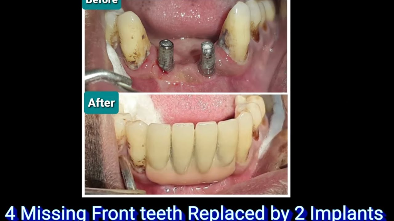 How crowns attach to dental implants ? Front teeth replacement Dental