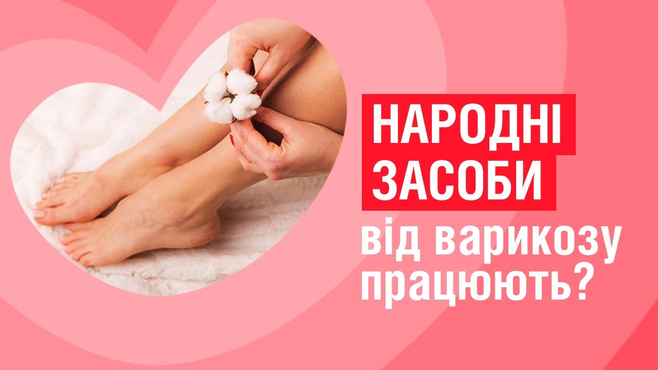 varicoza tratament terapeutic standarde medicale pentru tratamentul varicozei
