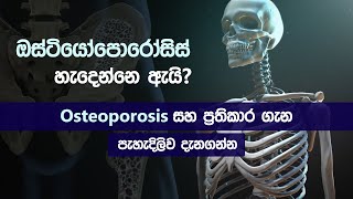 ඔස්ටියෝපොරෝසිස් ගැන දැනගමු ?| Osteoporosis | symptoms | causes | treatment in sinhala